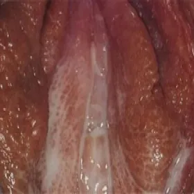 Wargi sromowe choroby zdjęcia rzeżączka