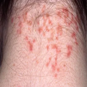 Wesz odzieżowa ugryzienia zdjęcia