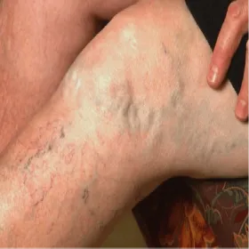 Widoczne żyły na nogach żylaki