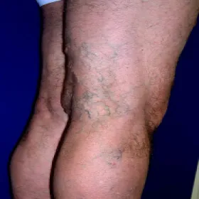 Widoczne żyły pod skórą na nogach