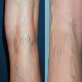 Widoczne niebieskie żyły na nogach