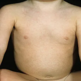 Wirusowe zmiany skórne zdjęcia 