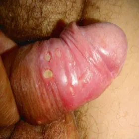 Wrzód weneryczny na prąciu