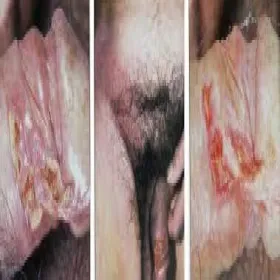 Wrzód-weneryczny zdjęcie