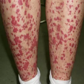 Wybroczyny na nogach małopłytkowość immunologiczna