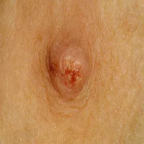 Wyciek z brodawki sutkowej