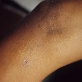 Wygląd Liszaj lśniący 