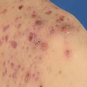 Wygląd trądziku piorunującego