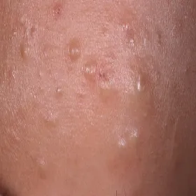 Wygląd zaskórniki zamknięte