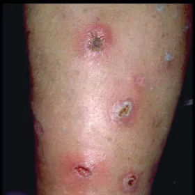 Wykwity pęcherzykowo-krostkowe na podłożu rumieniowym ecthyma 