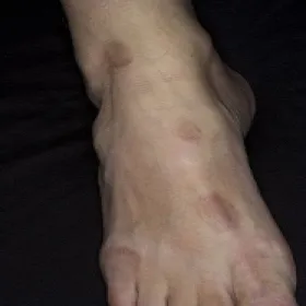 Wykwity skórne na stopie ziarniniak obrączkowaty 