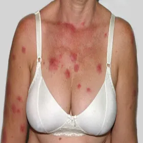 Wykwity skórne ostra gorączkowa dermatoza neutrofilowa 