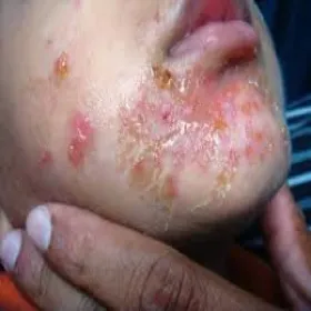 Wykwity skórne zdjęcia liszajec