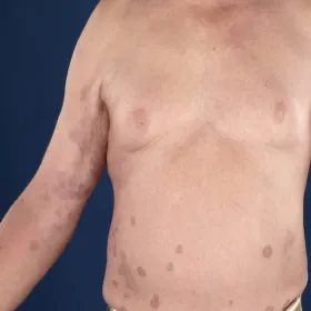 Wykwity skórne zdjęcia na brzuchu ziarniniak obrączkowaty 