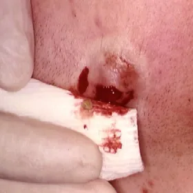 Wypływ z przetok bezwonny ropno-krwawy choroba promienica