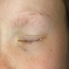 Wypadanie brwi choroba łysienie plackowate