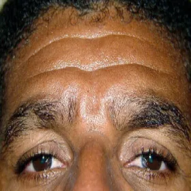 Wypadanie brwi u mężczyzn łysienie plackowate