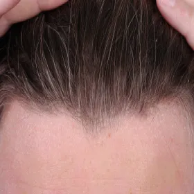 Wyprysk łojotokowy na skórze głowy