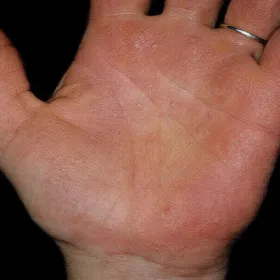 Wyprysk dyshydrotyczny na nikiel