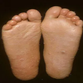 Wyprysk dyshydrotyczny na stopach