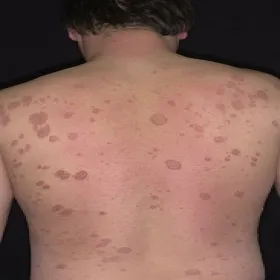 Wyprysk pieniążkowaty na plecach