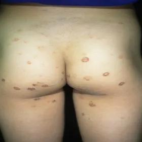 Wyprysk pieniążkowaty na pośladkach