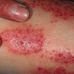 Wyprysk pieniążkowaty 