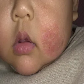 Wypryski na twarzy u dziecka AZS