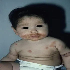 Wypryski na twarzy u niemowlaka AZS