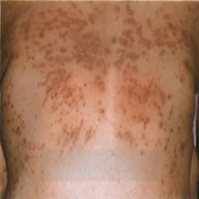 Wysypka grudkowa na plecach choroba Kyrle