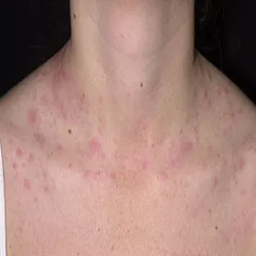 Wysypka klatka piersiowa szyja pokrzywka cholinergiczna 