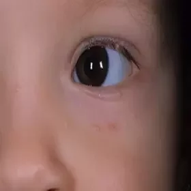 Wysypka koło oka u dziecka