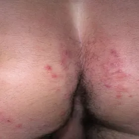 Wysypka między pośladkami choroba świerzb