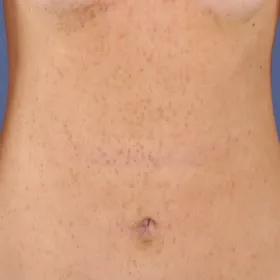 Wysypka na brzuchu choroba Dariera