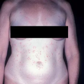 Wysypka na brzuchu i klatce piersiowej zapalenie mieszków włosowych