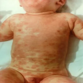 Wysypka na brzuchu u dziecka choroba Kawasakiego 