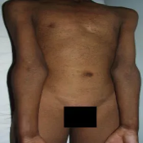 Wysypka na ciele u mężczyzny choroba Dariera