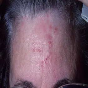 Wysypka na czole opryszczkowate zapalenie skóry 