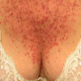 Wysypka na dekolcie choroba Dariera