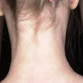 Wysypka na karku łupież Giberta