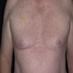 Wysypka na klatce piersiowej choroba Grovera