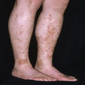 Wysypka na nogach zdjęcia