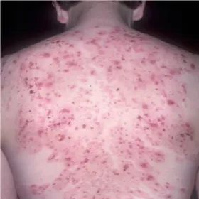 Wysypka na plecach choroba Duhringa 
