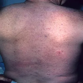 Wysypka na plecach choroba Grovera