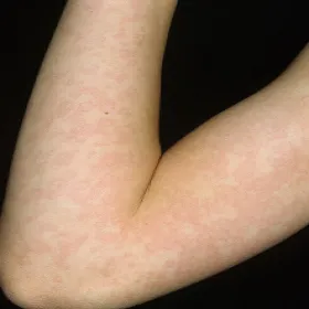 Wysypka na ręce rumień zakaźny