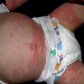 Wysypka na skórze u dziecka choroba Kawasaki