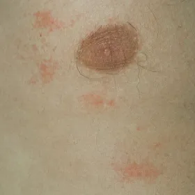 Wysypka na skórze u trenujących pokrzywka cholinergiczna 