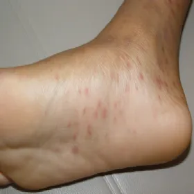 Wysypka na stopach łupież różowy Giberta