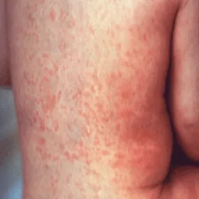 Wysypka odra u dziecka