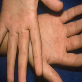 Wysypka pęcherzykowata na dłoniach